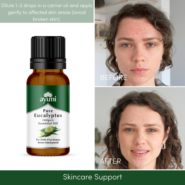 Ayumi Eucalyptus Oil, showing girl before and after use on skin