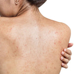 Women showing her back with Acne & Pimples