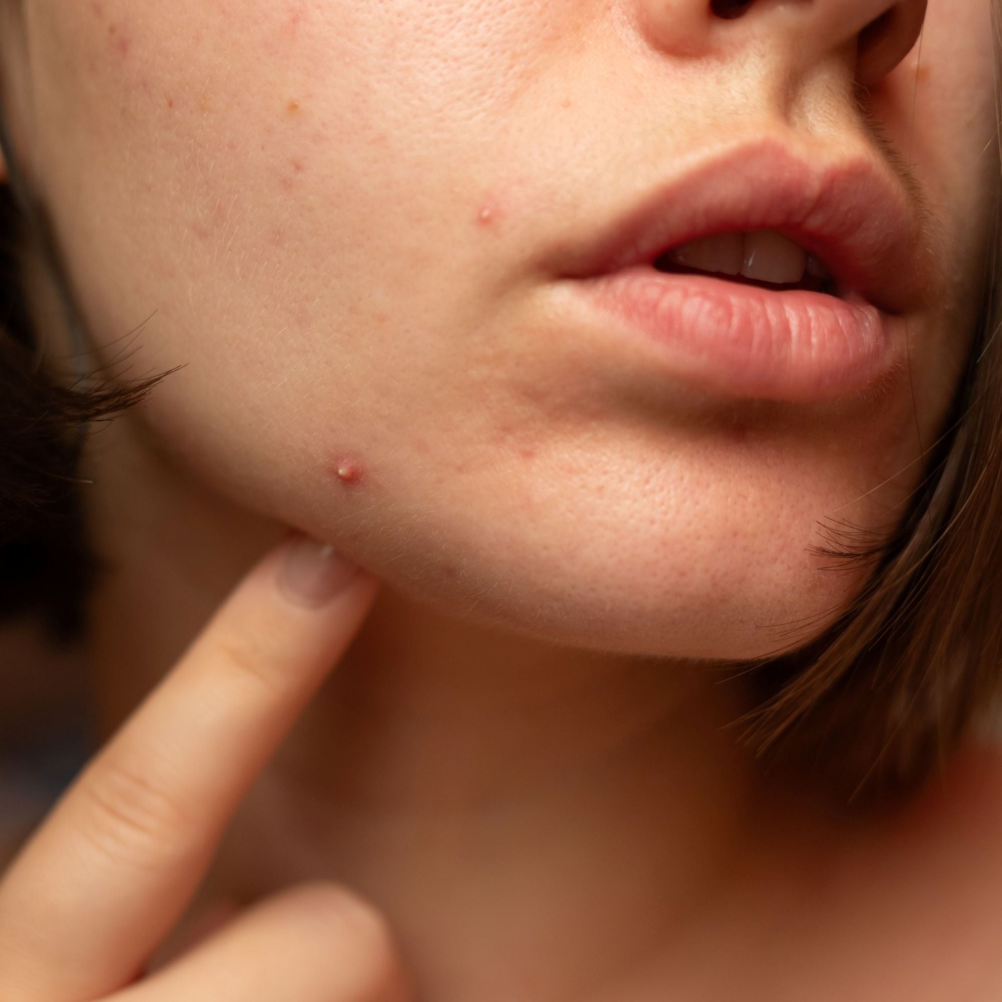 A teenager pointing with her finer at the acne on her face
