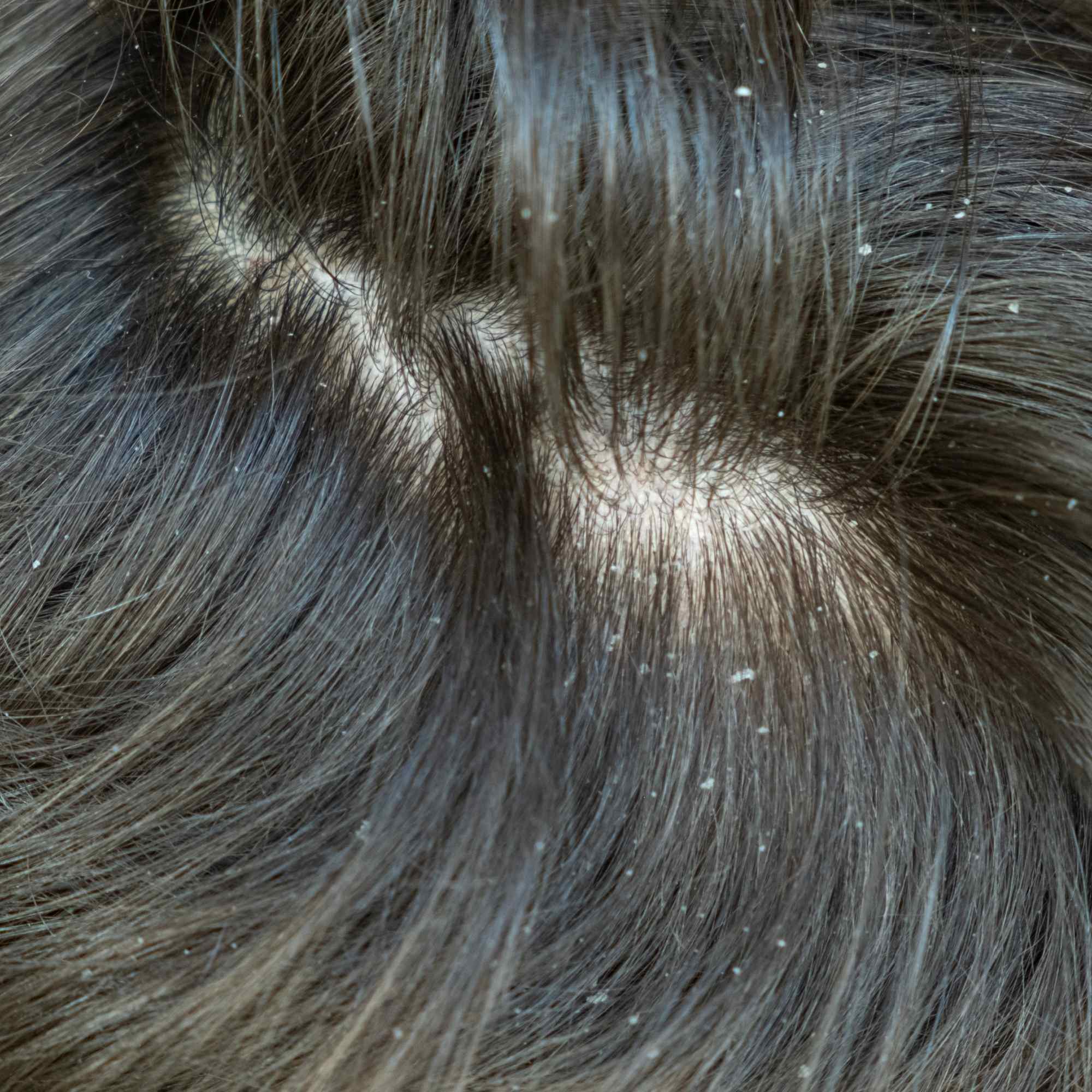 Close-up of brown hair with dandruff