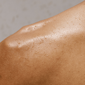 Blemish Prone Skin