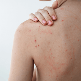 Body Acne