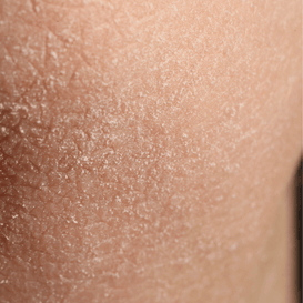 Dehydrated Skin