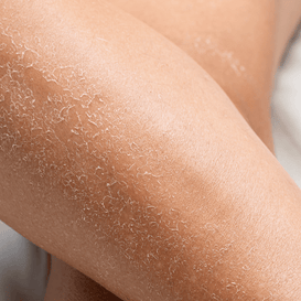 Dry Skin