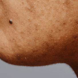Pigmentation