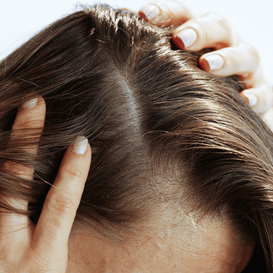 Dry Scalp