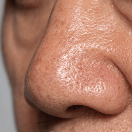 Clogged Pores