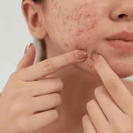 Pimple
