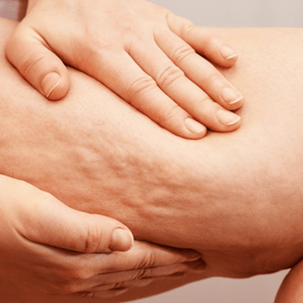 Cellulite