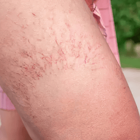 Stretch Marks