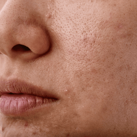 Blackheads