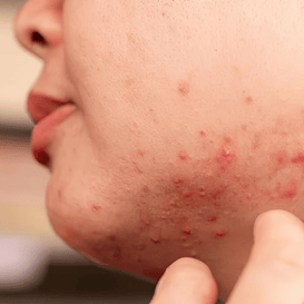 Blemishes