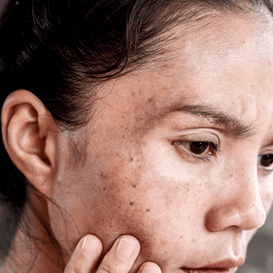 Dark Spots