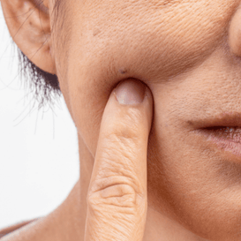 Dry Skin