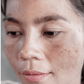Hyperpigmentation