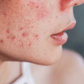Sensitive Skin